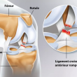 RUPTURE LIGAMENT CROISE GENOU