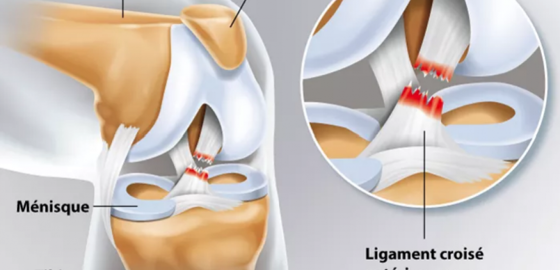 RUPTURE LIGAMENT CROISE GENOU